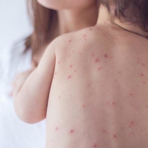 CALIFORNIA CONFIRMA 17 CASOS DE SARAMPIÓN Y EMITE ALERTA SANITARIA ESTATAL